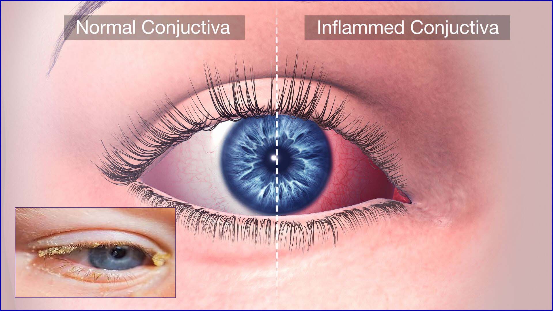 👉 Conjunctivitis (Pink Eye): Causes, Symptoms, Treatment, and Prevention Explained